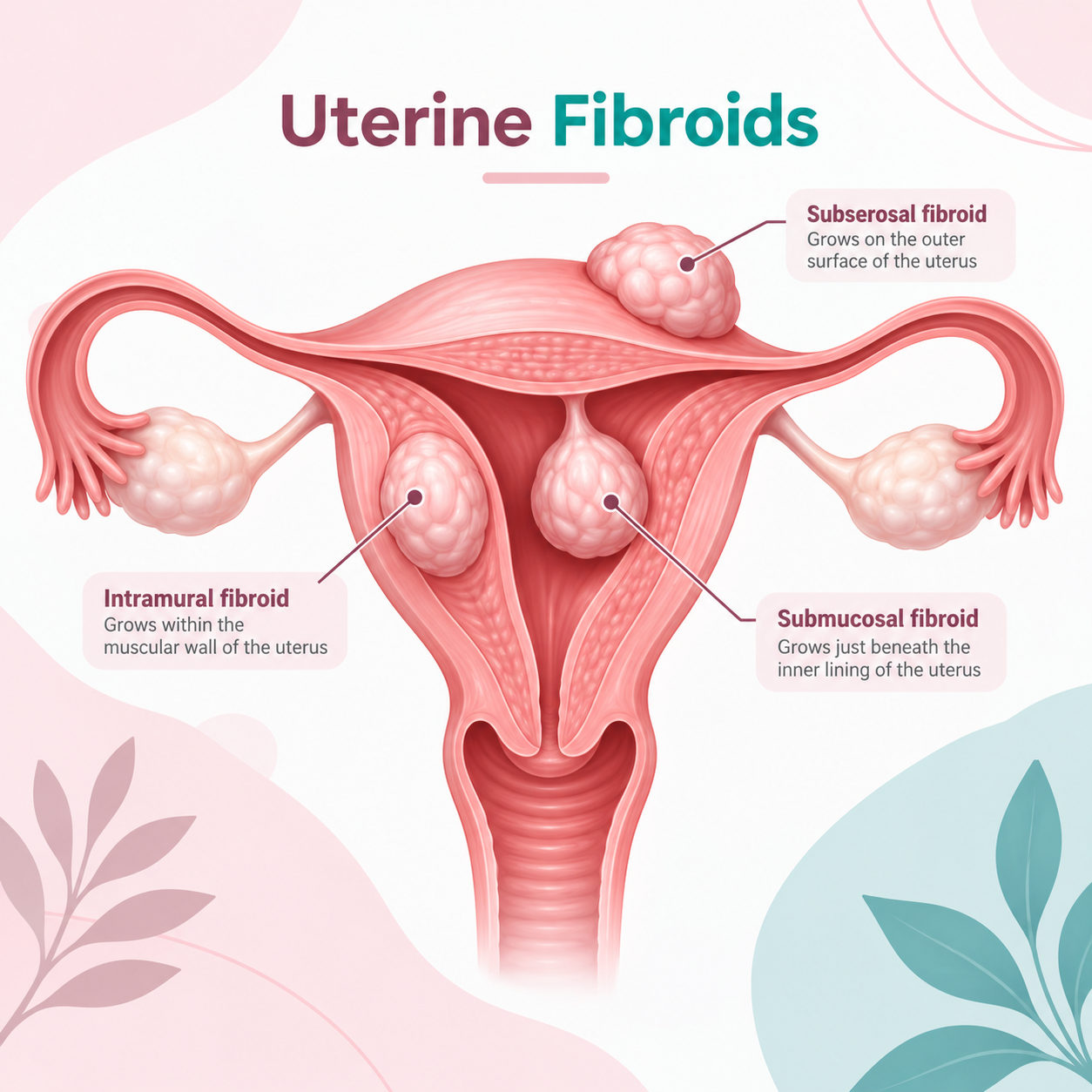Uterine Fibroids: Symptoms, Diagnosis & Treatment